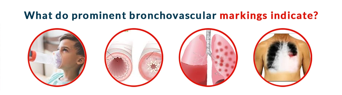 Prominent Bronchovascular Markings Indicate
